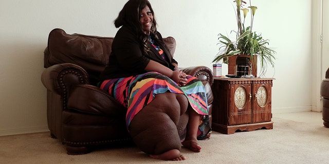 Ada Thompson, 38, said she refuses to let her rare disorder, which has left her with massive swelling in her right leg, slow her down or prevent her from spreading happiness.