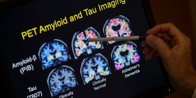 Scientists know that long before the memory problems of Alzheimer's become obvious, people experience more subtle changes in their thinking and judgment.