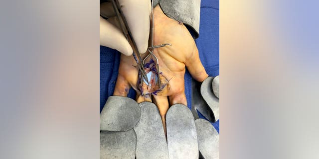 Norgart severed a nerve and sliced through an artery when she accidentally stabbed herself in the hand while trying to get the pit out of an avocado.