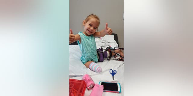 Victoria Komada has bilateral tibial hemimelia - a congenital deformity which causes babies to be born with deformed legs and missing bones.