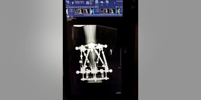 Victoria had her first nine-hour operation on July 24, when her right leg was amputated above her knee and pins were put into her left leg before a fixator was attached.