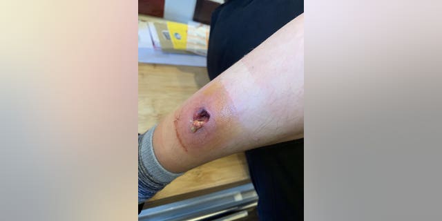 Mom Claims Spider Bite Left Son With Gaping Hole In Leg Healthmedicinentral