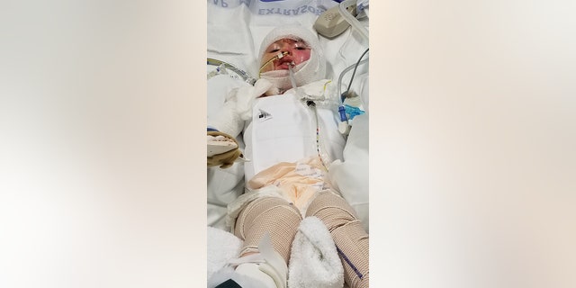 In just three minutes, Kenzie sustained traumatic burns on 68 percent of her body.