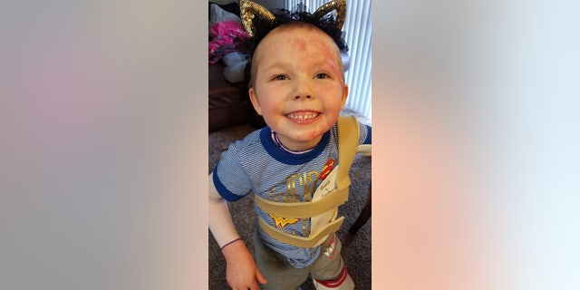 "Unfortunately on her third surgery, Kenzie had to have her beautiful blonde hair removed, as the burns had covered her scalp also,” mom Jessica revealed.