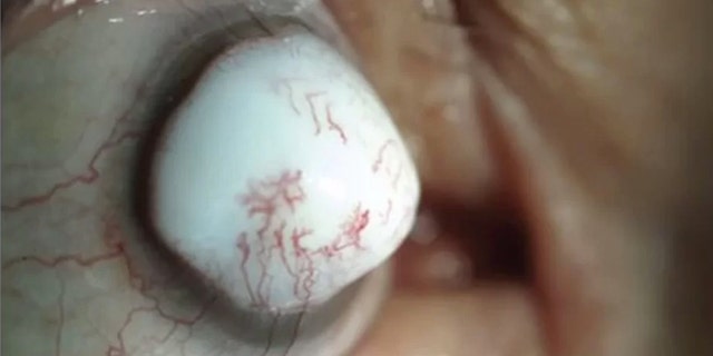 This odd eye problem is the result of a rare lesion on a man's eyeball,