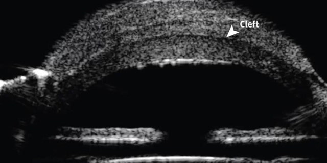 Test results showed that the man had a "corneal keloid," a rare type of lesion on the cornea