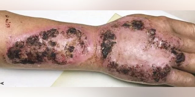 The unnamed 65-year-old told doctors at the Sun Yat-sen Memorial Hospital in Guangzhou, China, that he had suffered a trauma to his arm months earlier.