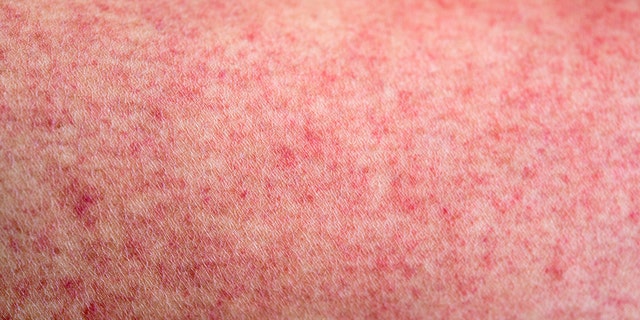 covid rash pictures in adults