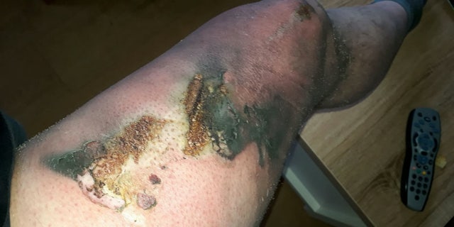 Allsopp said he is fighting off an infection before doctors can schedule a skin graft to repair the damage.