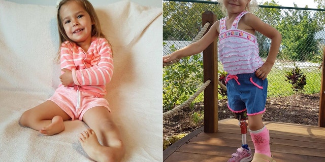 Victoria's family found a surgeon in Florida who performed two miracle surgeries to save one of her legs and give her the ability to walk for the first time.