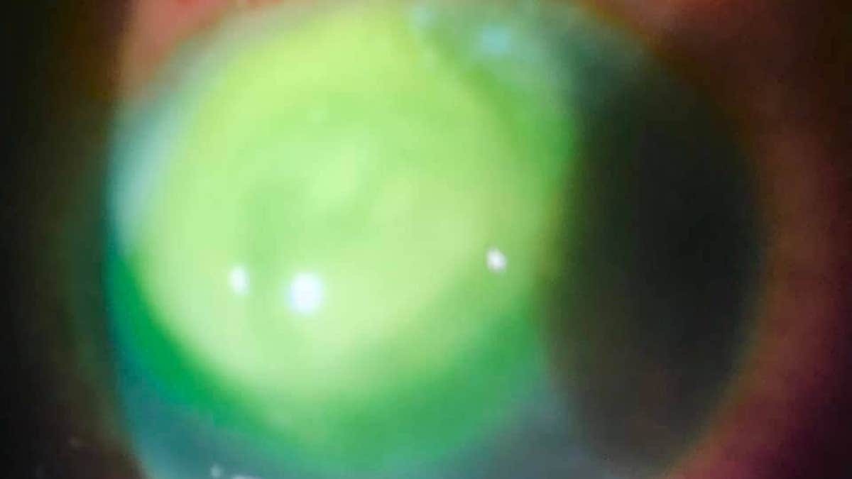 The infection is typically a result of bacteria that are found in the environment.