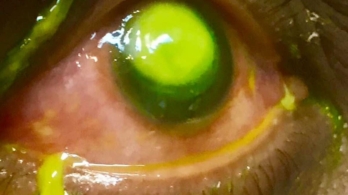The eye doctor used green fluorescein dye to view the damaged areas of the eye.