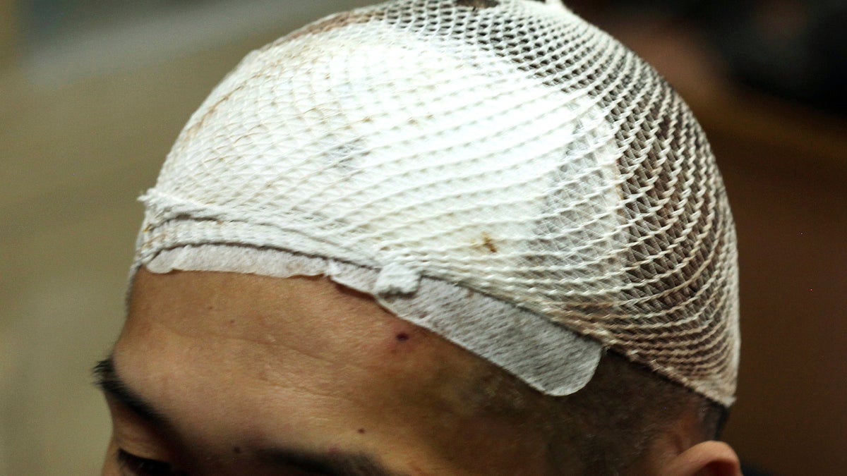 Bloodied white mesh covers the head of a methamphetamine addict named Yan on Monday, Oct. 29, 2018, three days after he had a deep brain stimulation device implanted as part of a clinical trial at Ruijin Hospital in Shanghai, China.