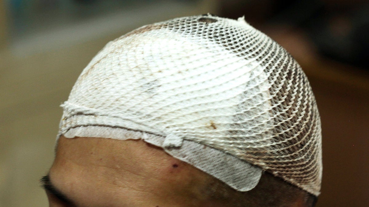 Bloodied white mesh covers the head of a methamphetamine addict named Yan on Monday, Oct. 29, 2018, three days after he had a deep brain stimulation device implanted as part of a clinical trial at Ruijin Hospital in Shanghai, China.