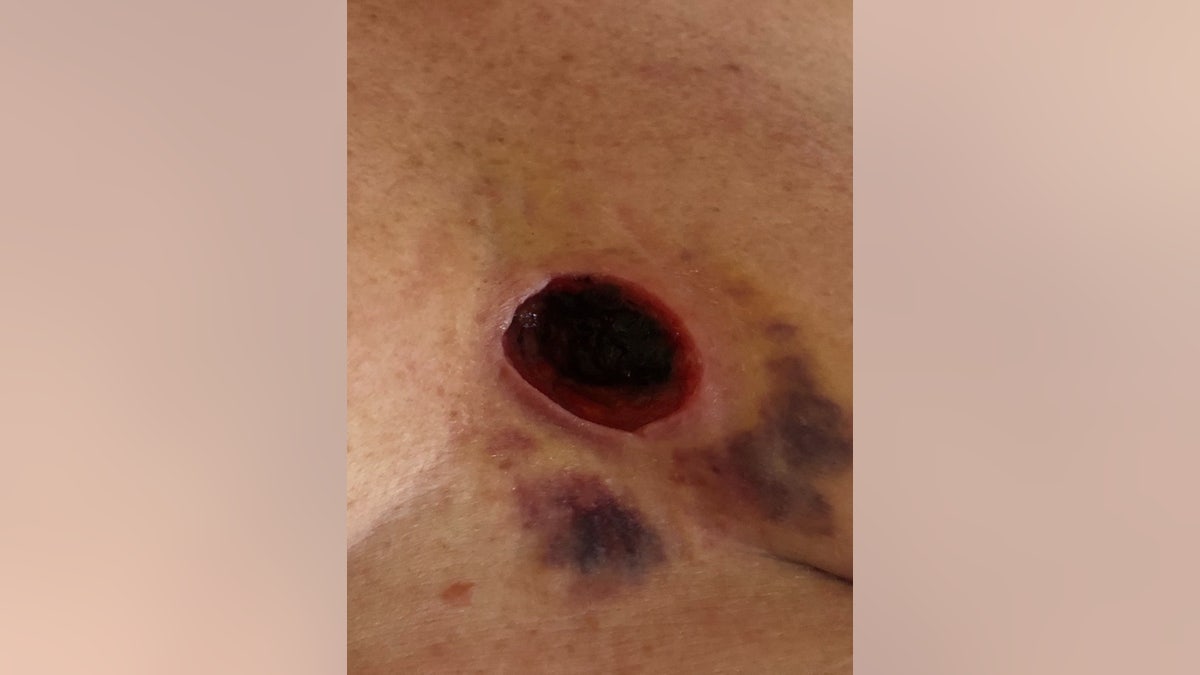 Woman gets cyst caused by bra cut out of chest