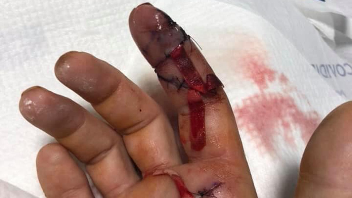 Milward said a striper's fin sliced open his finger while he was fishing.