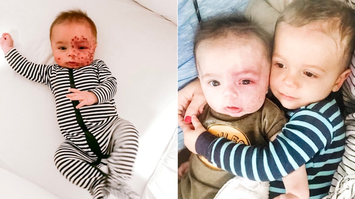 Leo, pictured left after a laser treatment and right with his older brother Leo, was diagnosed with Sturge-Weber Syndrome (SWS) after doctors noticed a large birthmark covering half of his face when he was born.