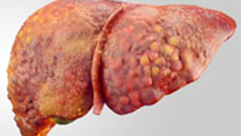 Mom, 63, cured of hepatitis after receiving part of liver from son, 37, in first-of-kind 3-D surgery: reports