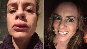 Mom says reaction to cheap teeth-whitening kit left her with swollen, blistered lips