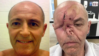 Dad loses eye, part of nose after common symptom leads to cancer diagnosis