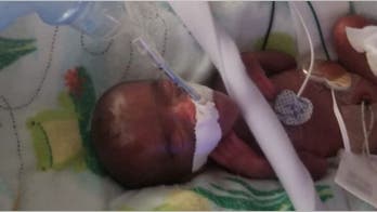 San Diego hospital announces birth of world’s tiniest surviving baby