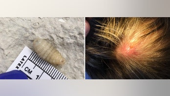 Woman’s painful, oozing lumps on scalp were botfly larvae