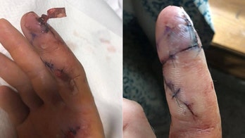 Fisherman says he nearly lost finger after contracting bacterial infection in cut from fish fin
