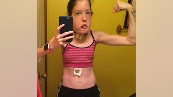 Woman born with rare cyst condition defies odds, becomes disability rights advocate