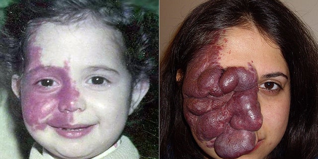 The birthmark continued to grow as Ellahe aged, and she endured callous remarks from strangers who thought she was contagious.