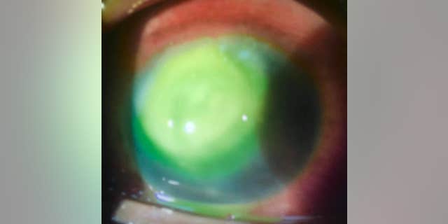 The infection is usually the result of a bacteria present in the environment.