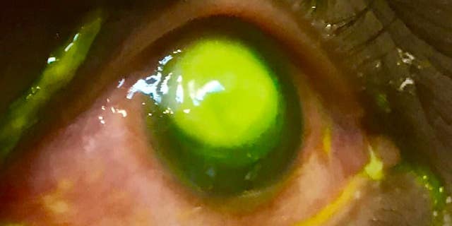 The eye doctor used green fluorescein dye to view the damaged areas of the eye.