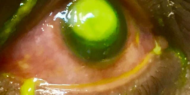 The ophthalmologist used a green fluorescein dye to visualize the damaged areas of the eye.