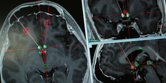 This Monday, Oct. 29, 2018 photo shows a brain scan of a methamphetamine addict with the path of electrodes that doctors at Ruijin Hospital in Shanghai, China implanted to stimulate an area of the brain associated with addiction.