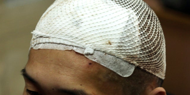 Bloodied white mesh covers the head of a methamphetamine addict named Yan on Monday, Oct. 29, 2018, three days after he had a deep brain stimulation device implanted as part of a clinical trial at Ruijin Hospital in Shanghai, China.