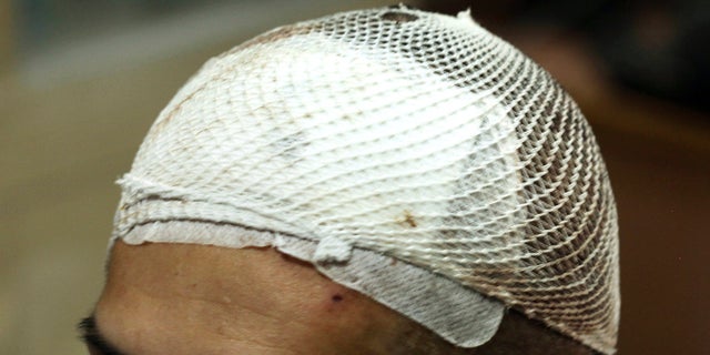 Bloodied white mesh covers the head of a methamphetamine addict named Yan on Monday, Oct. 29, 2018, three days after he had a deep brain stimulation device implanted as part of a clinical trial at Ruijin Hospital in Shanghai, China.