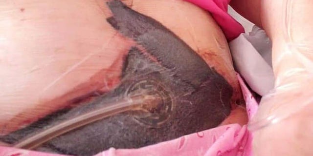 Just days after the operation, she noticed her skin was turning black and began asking for help.