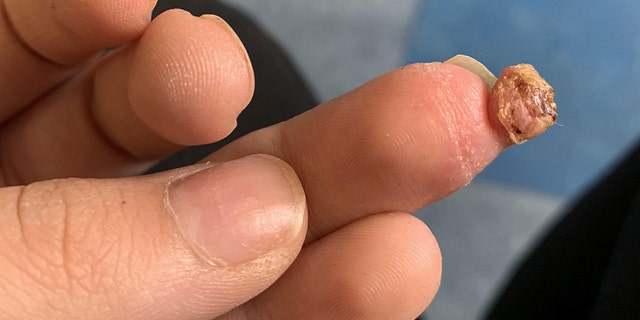 Eventually, a doctor was able to cut the growth out of her finger, but she said she has now sworn off fake nails.