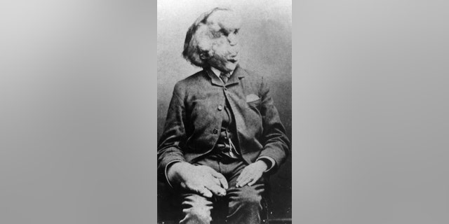Joseph Carey Merrick (Photo: Universal History Archive/UIG via Getty Images)