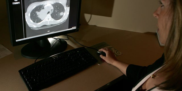 A radiology technologist examines the scan of a lung with a tumor at the UCSF Cancer Center in San Francisco. 