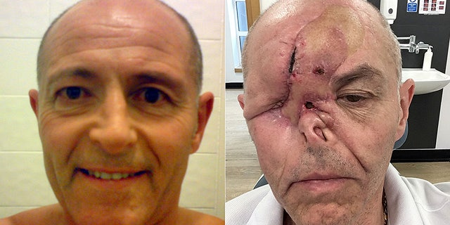 Graeme said he and his doctor initially thought his watery eye was a symptom of conjunctivitis or "dry eye."