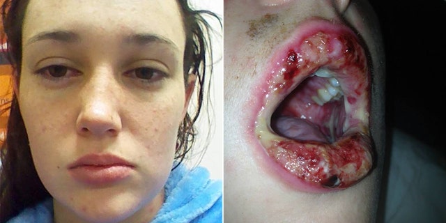 Danika Heron's reaction started as a rash, which was allegedly mistaken for chicken pox or herpes before a doctor recognized the seriousness of her condition.