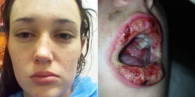 Danika Heron's reaction started as a rash, which was allegedly mistaken for chicken pox or herpes before a doctor recognized the seriousness of her condition.