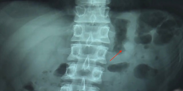 The AirPod in Ben Hsu's stomach. (Asian thread)