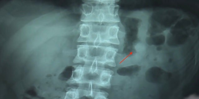 The AirPod in Ben Hsu's stomach. (Asia Wire)