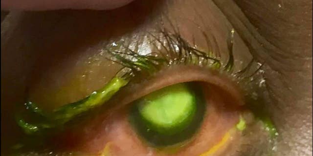 Dr. Patrick Vollmer of the Vita Eye Clinic in North Carolina shared several graphic images of an eye infection that he said was a result of sleeping in contact lenses.