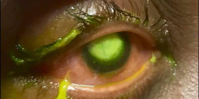 Dr. Patrick Vollmer of the Vita Eye Clinic in North Carolina shared several graphic images of an eye infection that he thought resulted from sleep in contact lenses.