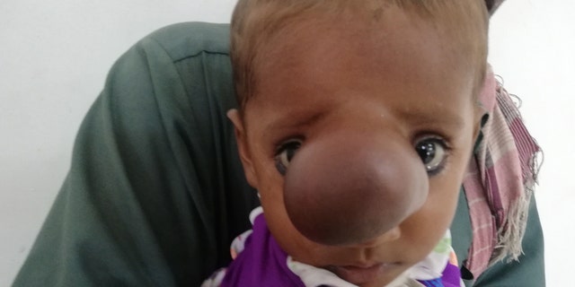 The boy's parents say he was born with a tiny bump on his nose that has continued to grow as he ages.