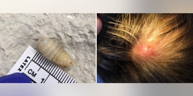 One larva exited her head after Vaseline was applied over the opening, but the other, which died while under her scalp, required surgical removal.
