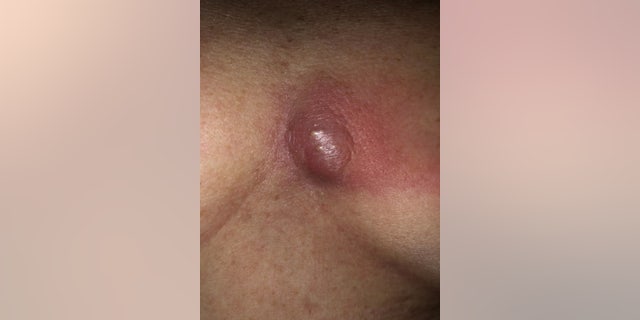 McConnell's chest pictured before surgery.