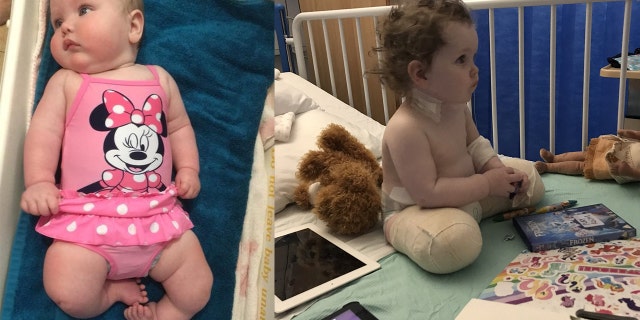 Freya's parents said they weren't given her formal diagnosis until two weeks after birth, and after researching options decided early amputation was the best course for their daughter.